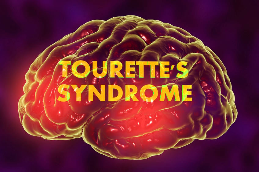 neurofeedback for tourette syndrome, neurotherapy for tourette syndrome, neurofeedback for tourette's syndrome, tourette syndrome, tourette's syndrome
